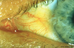 /1_VAA/4_BH/Bulbaere_BH/Pterygium/415(4).jpg