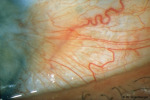 /1_VAA/4_BH/Bulbaere_BH/Pterygium/415(5).jpg